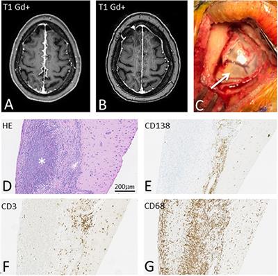 Use of Cerebrospinal Fluid Biomarkers in Diagnosis and Monitoring of Rheumatoid Meningitis